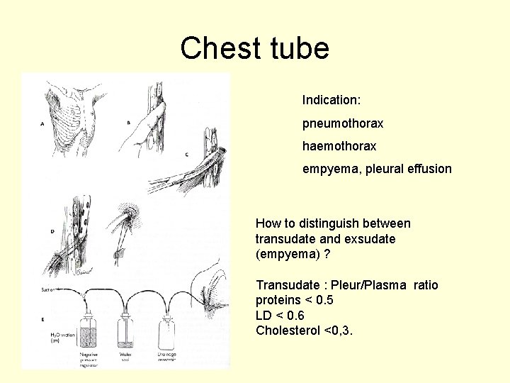 Chest tube Indication: pneumothorax haemothorax empyema, pleural effusion How to distinguish between transudate and