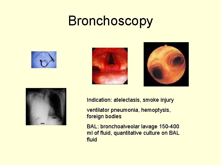 Bronchoscopy Indication: atelectasis, smoke injury ventilator pneumonia, hemoptysis, foreign bodies BAL: bronchoalveolar lavage 150