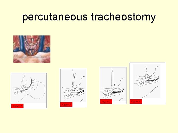 percutaneous tracheostomy 