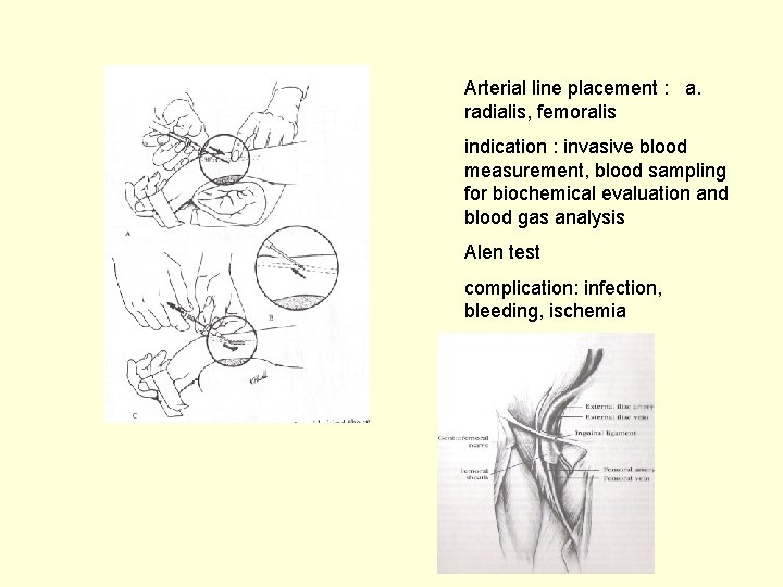 Arterial line placement : a. radialis, femoralis indication : invasive blood measurement, blood sampling