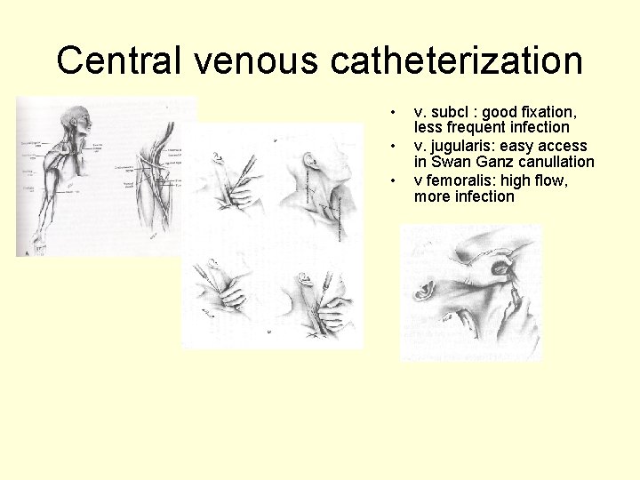 Central venous catheterization • • • v. subcl : good fixation, less frequent infection