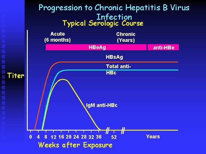 Progression to Chronic Hepatitis B Virus Infection Typical Serologic Course Acute (6 months) Chronic