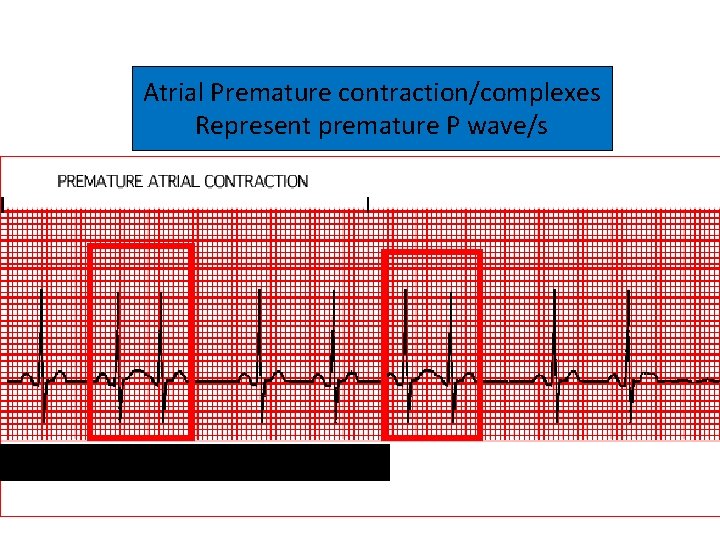 Atrial Premature contraction/complexes Represent premature P wave/s 