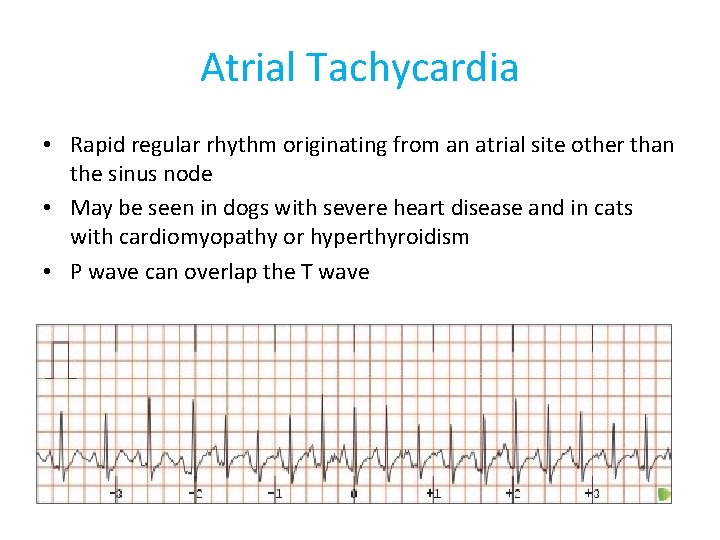 Atrial Tachycardia • Rapid regular rhythm originating from an atrial site other than the