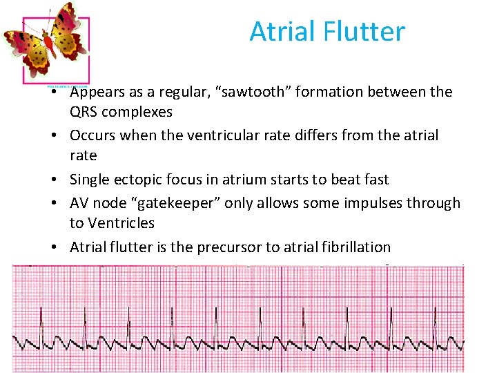 Atrial Flutter • Appears as a regular, “sawtooth” formation between the QRS complexes •