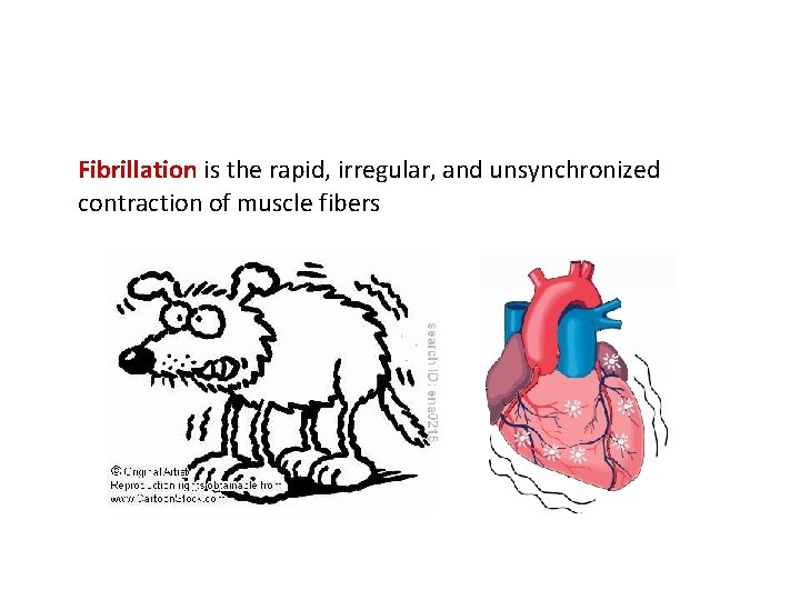 Fibrillation is the rapid, irregular, and unsynchronized contraction of muscle fibers 