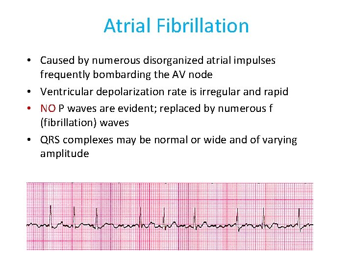 Atrial Fibrillation • Caused by numerous disorganized atrial impulses frequently bombarding the AV node