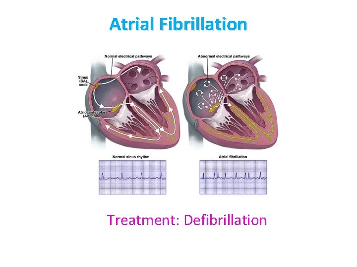 Atrial Fibrillation Treatment: Defibrillation 