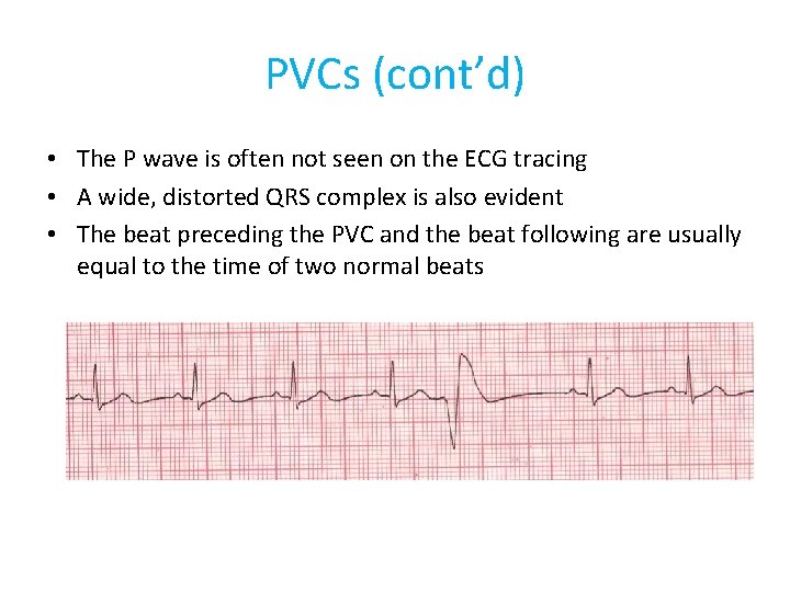 PVCs (cont’d) • The P wave is often not seen on the ECG tracing