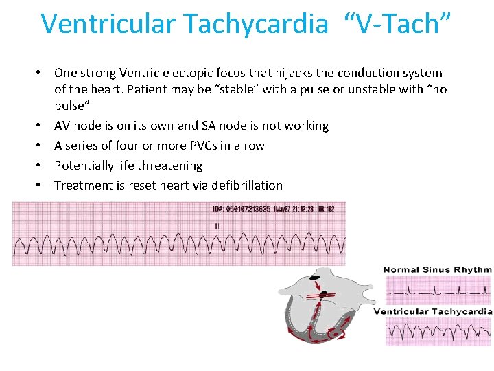 Ventricular Tachycardia “V-Tach” • One strong Ventricle ectopic focus that hijacks the conduction system