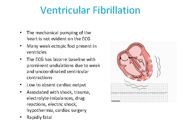 Ventricular Fibrillation • The mechanical pumping of the heart is not evident on the