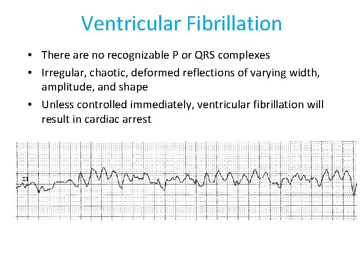 Ventricular Fibrillation • There are no recognizable P or QRS complexes • Irregular, chaotic,