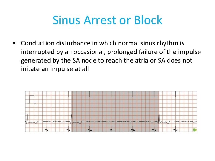 Sinus Arrest or Block • Conduction disturbance in which normal sinus rhythm is interrupted