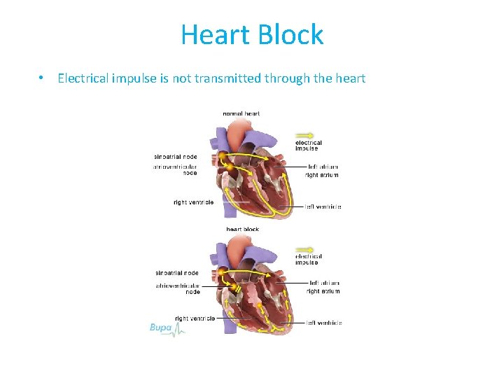 Heart Block • Electrical impulse is not transmitted through the heart 