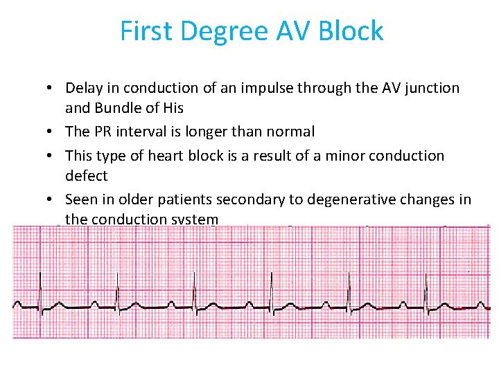 First Degree AV Block • Delay in conduction of an impulse through the AV