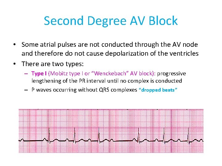Second Degree AV Block • Some atrial pulses are not conducted through the AV