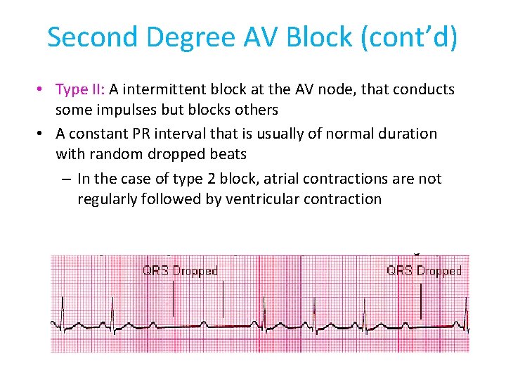 Second Degree AV Block (cont’d) • Type II: A intermittent block at the AV