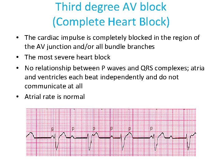 Third degree AV block (Complete Heart Block) • The cardiac impulse is completely blocked