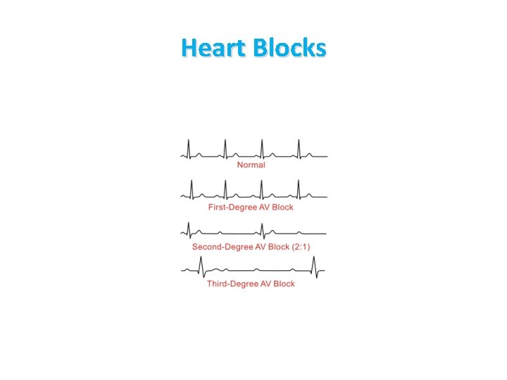 Heart Blocks 