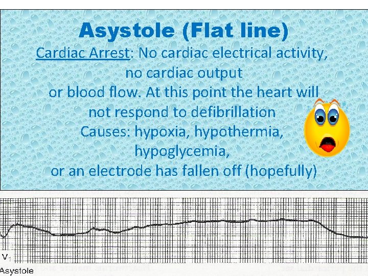 Asystole (Flat line) Cardiac Arrest: No cardiac electrical activity, no cardiac output or blood