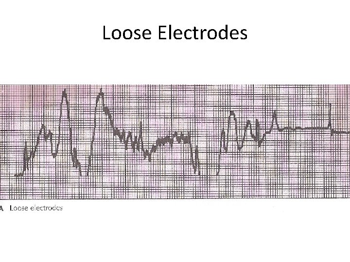 Loose Electrodes 