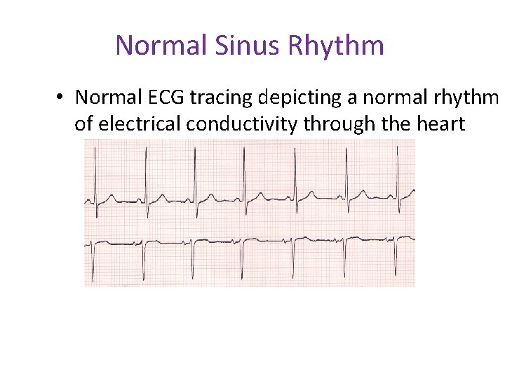 Normal Sinus Rhythm • Normal ECG tracing depicting a normal rhythm of electrical conductivity