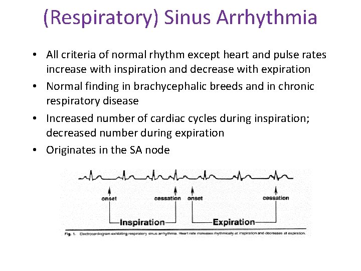 (Respiratory) Sinus Arrhythmia • All criteria of normal rhythm except heart and pulse rates