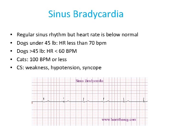 Sinus Bradycardia • • • Regular sinus rhythm but heart rate is below normal