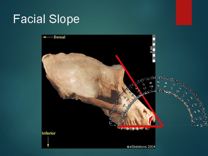 Facial Slope 