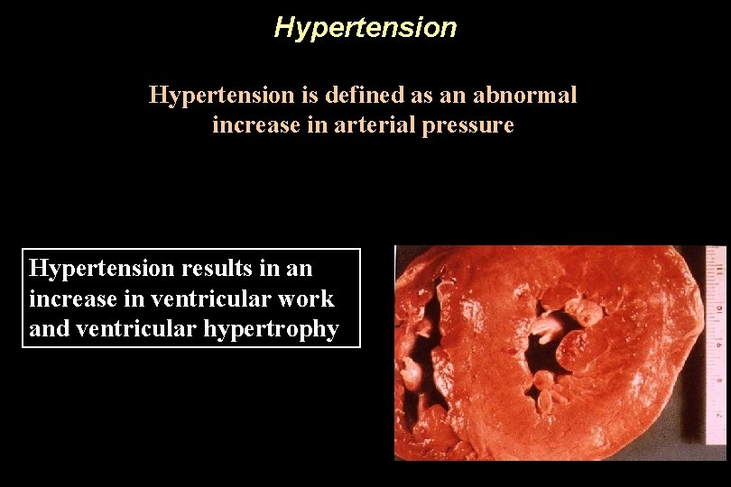 Hypertension is defined as an abnormal increase in arterial pressure Hypertension results in an