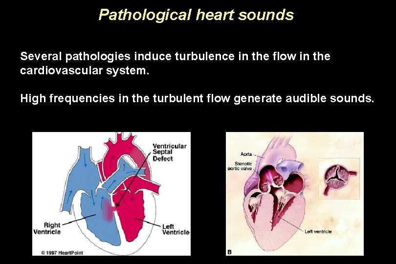 Pathological heart sounds Several pathologies induce turbulence in the flow in the cardiovascular system.