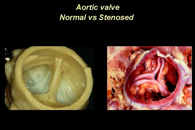 Aortic valve Normal vs Stenosed 