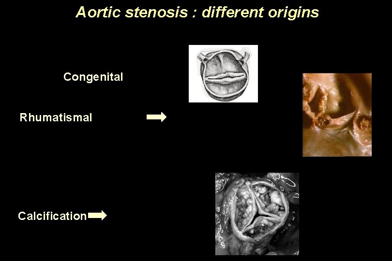 Aortic stenosis : different origins Congenital Rhumatismal Calcification 
