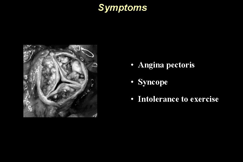 Symptoms • Angina pectoris • Syncope • Intolerance to exercise 
