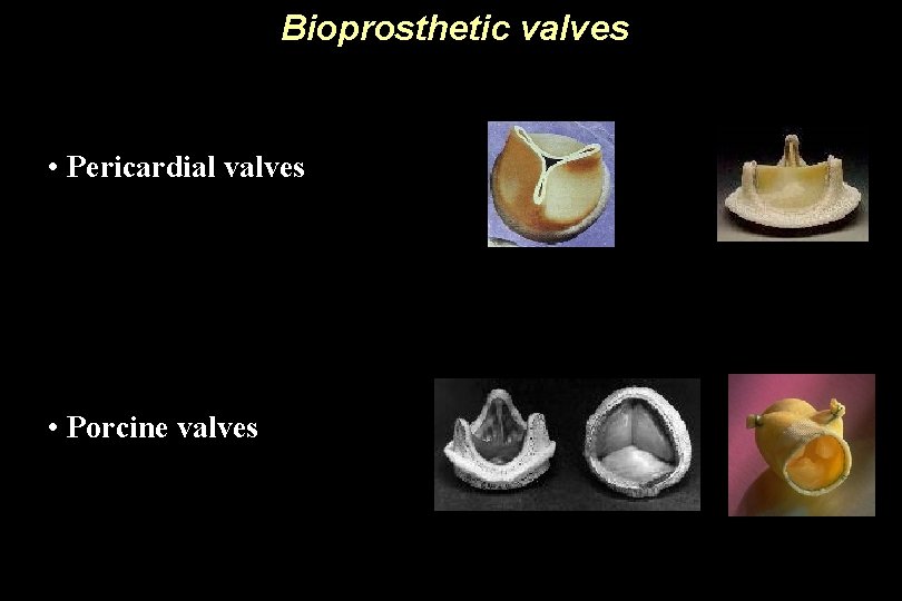 Bioprosthetic valves • Pericardial valves • Porcine valves 