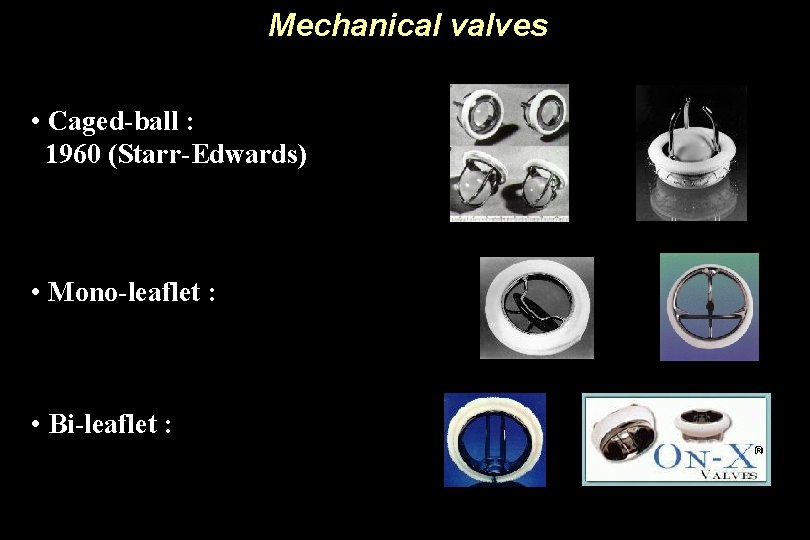 Mechanical valves • Caged-ball : 1960 (Starr-Edwards) • Mono-leaflet : • Bi-leaflet : 