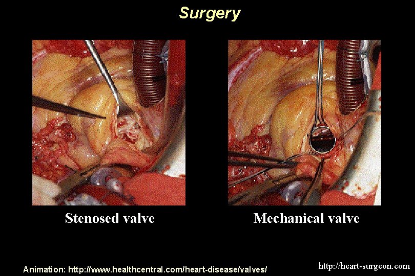 Surgery Stenosed valve Mechanical valve Animation: http: //www. healthcentral. com/heart-disease/valves/ http: //heart-surgeon. com 