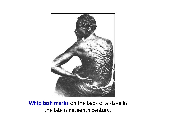 Whip lash marks on the back of a slave in the late nineteenth century. Whip lash marks on the back of a slave in the late nineteenth century.