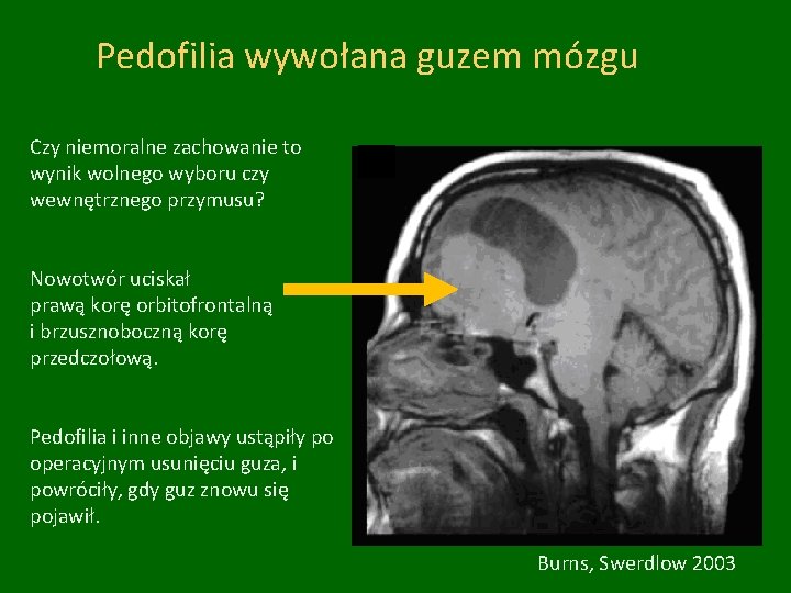 Pedofilia wywołana guzem mózgu Czy niemoralne zachowanie to wynik wolnego wyboru czy wewnętrznego przymusu?