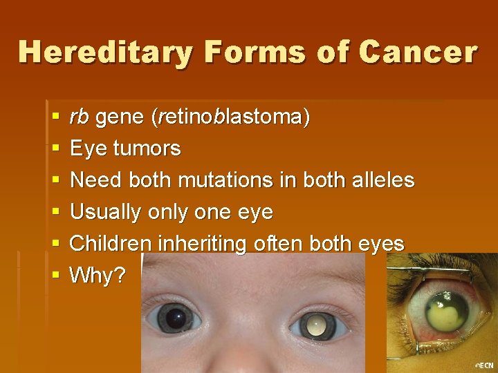 Hereditary Forms of Cancer § § § rb gene (retinoblastoma) Eye tumors Need both