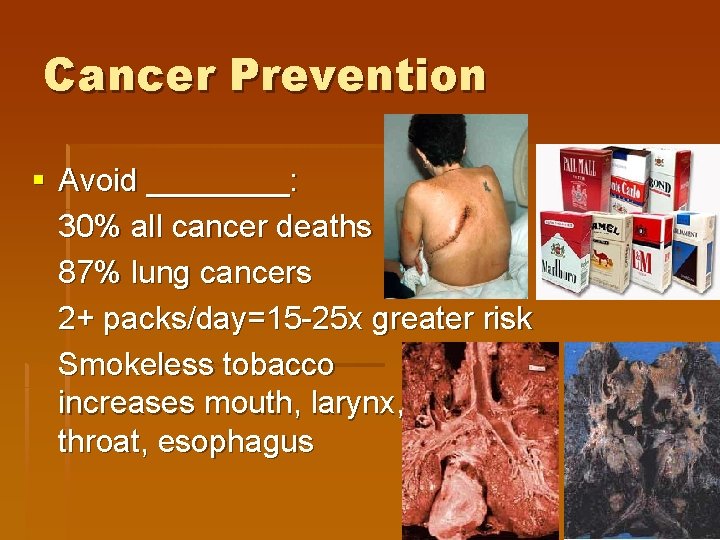 Cancer Prevention § Avoid ____: 30% all cancer deaths 87% lung cancers 2+ packs/day=15