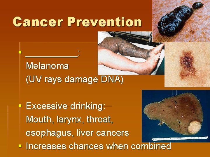 Cancer Prevention § _____: Melanoma (UV rays damage DNA) § Excessive drinking: Mouth, larynx,