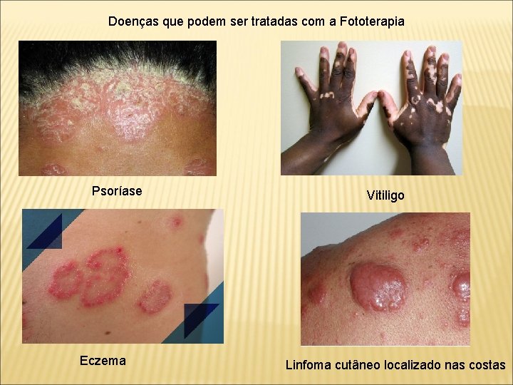 Doenças que podem ser tratadas com a Fototerapia Psoríase Eczema Vitiligo Linfoma cutâneo localizado