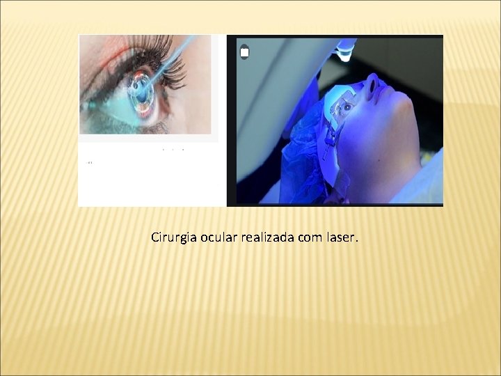 Cirurgia ocular realizada com laser. 