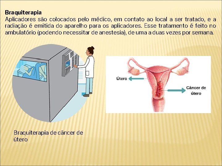 Braquiterapia Aplicadores são colocados pelo médico, em contato ao local a ser tratado, e