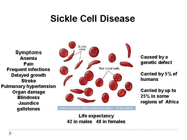 Sickle Cell Disease Symptoms Caused by a genetic defect Anemia Pain Frequent infections Delayed