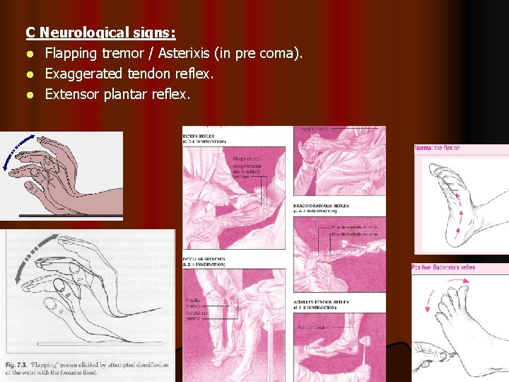 C Neurological signs: l Flapping tremor / Asterixis (in pre coma). l Exaggerated tendon