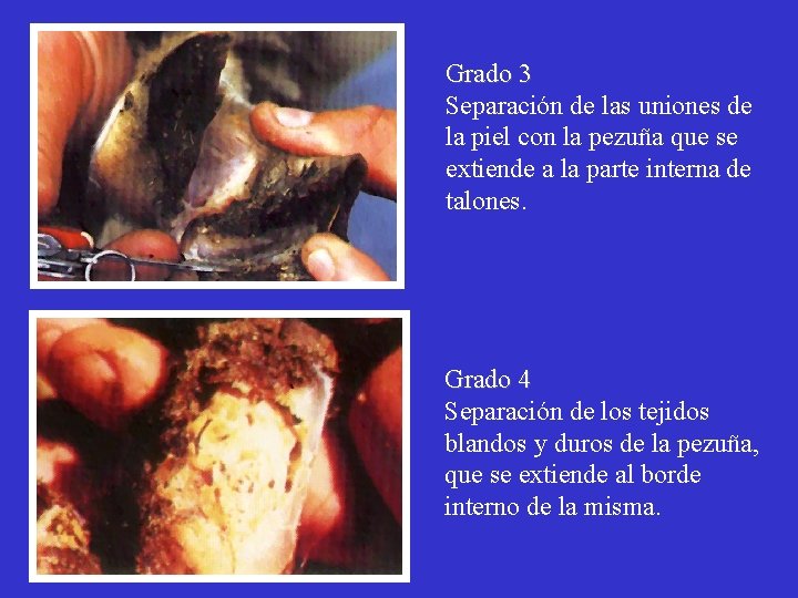 Grado 3 Separación de las uniones de la piel con la pezuña que se