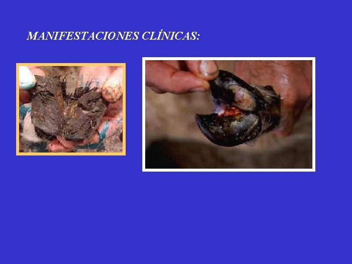 MANIFESTACIONES CLÍNICAS: 