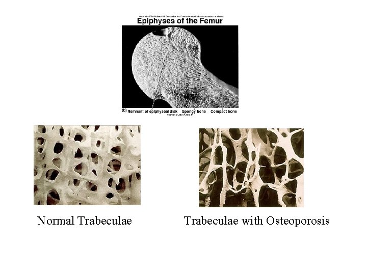 Normal Trabeculae with Osteoporosis 